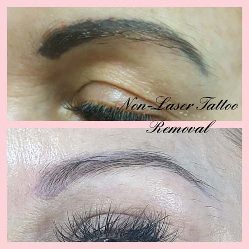 laser eyebrow tattoo removal melbourne